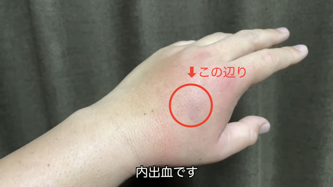 ｜死亡例もある世界最強の『毒魚』に刺されてみた結果→「トンカチで骨を殴られたみたい」身体を張って毒の威力を大検証。「絶対にマネしないで」