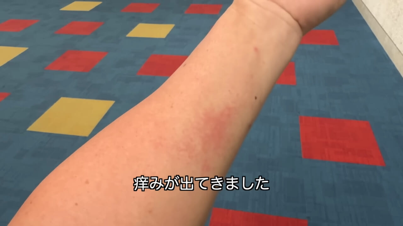 ｜「くぅーっ、うわぁ」海水浴場によく出現”猛毒クラゲ”に刺されてみた。目を背けたくなるひどい症例もあります。