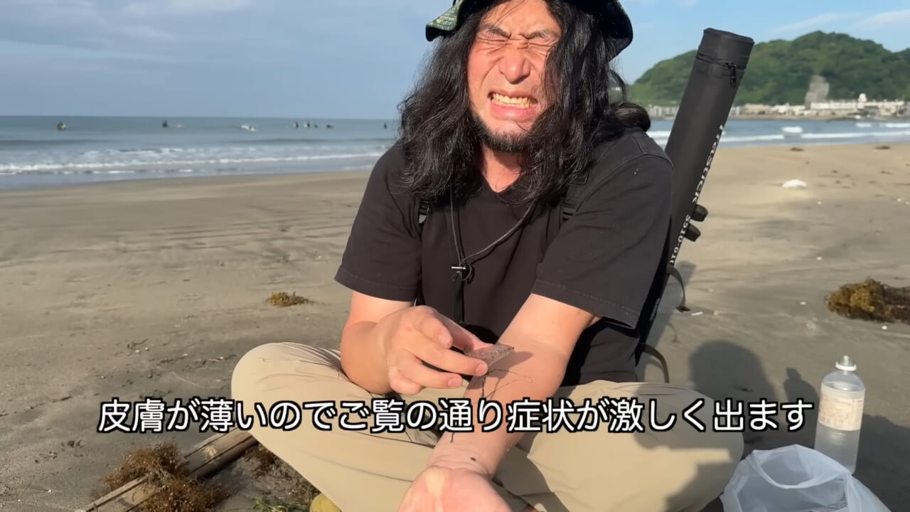 |「くぅーっ、うわぁ」海水浴場によく出現”猛毒クラゲ”に刺されてみた。目を背けたくなるひどい症例もあります。