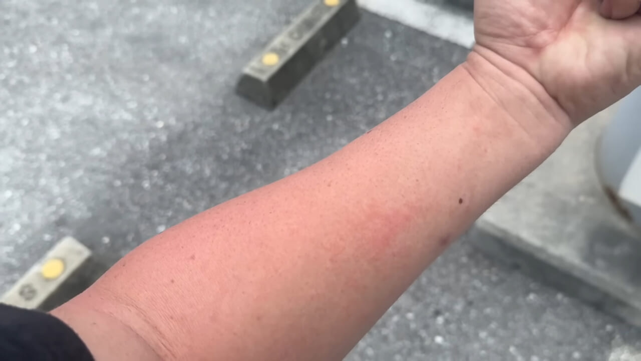 |「くぅーっ、うわぁ」海水浴場によく出現”猛毒クラゲ”に刺されてみた。目を背けたくなるひどい症例もあります。