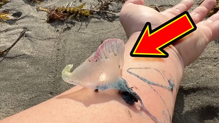 「くぅーっ、うわぁ」海水浴場によく出現”猛毒クラゲ”に刺されてみた。目を背けたくなるひどい症例もあります。