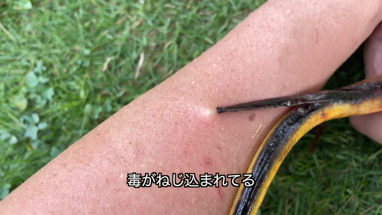 ｜「うぉー、痛ってえええ」東京湾にも生息する『身近な危険生物』に刺されたらこうなった。「この黒いネバネバが“毒液”です」