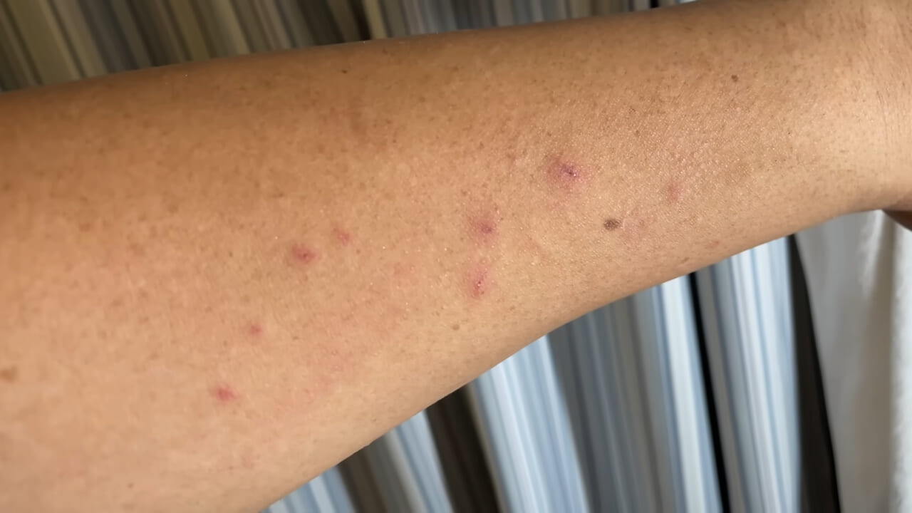 ｜「うぉー、痛ってえええ」東京湾にも生息する『身近な危険生物』に刺されたらこうなった。「この黒いネバネバが“毒液”です」