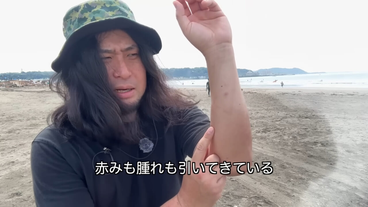 |「くぅーっ、うわぁ」海水浴場によく出現”猛毒クラゲ”に刺されてみた。目を背けたくなるひどい症例もあります。